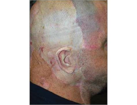 Scalp Skin Graft Scalp