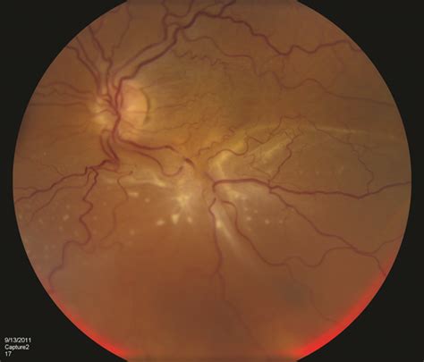 Complex Retinal Detachment Retina Specialists Of North Alabama LLC