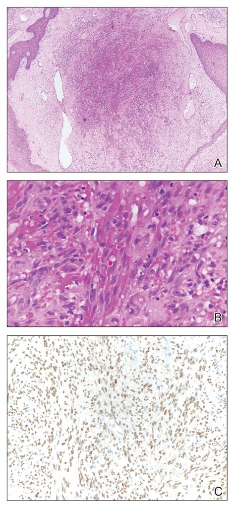 Well Circumscribed Tumor On The Hand Mdedge