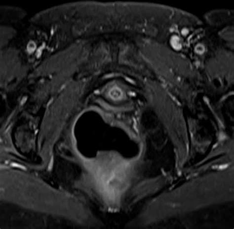 Mri T1 Fat Saturated Post Contrast Gadolinium Sequence Physics And