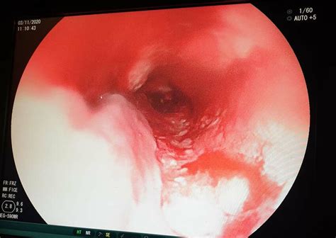 Ogd Showing A Fungating Tumour At Cm From The Upper Incisors With