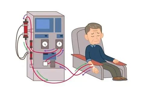 如何保护血液透析患者的“生命线”——自体动静脉内瘘？ 知乎