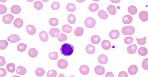 What is monoclonal B-cell lymphocytosis (MBL)?