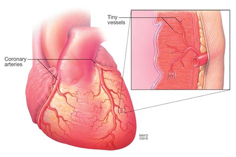 Small Vessel Disease Symptoms Causes Mayo Clinic