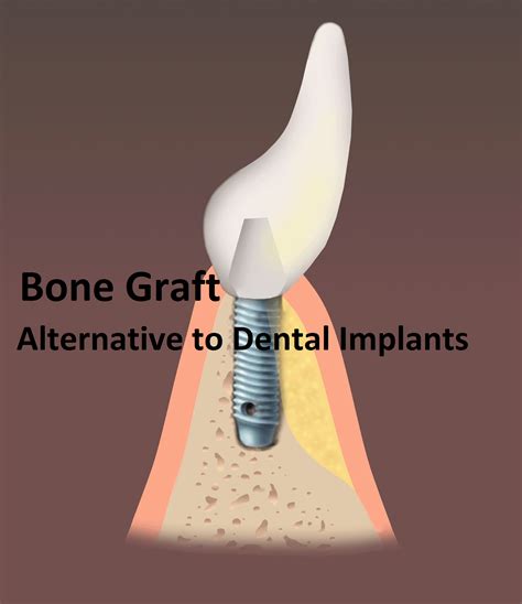 Bone Graft – Dental treatment That Works well - RRDCH