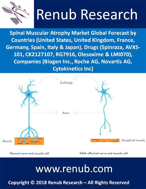 Global Spinal Muscular Atrophy Market Size Spinal Muscular Flickr