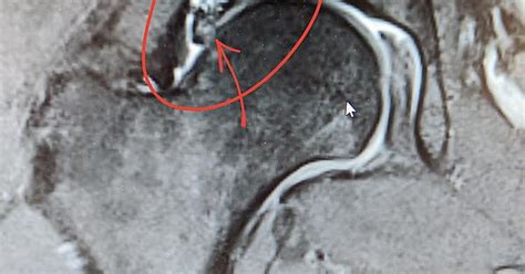 Mri Right Hip Labral Tear And Fai Album On Imgur