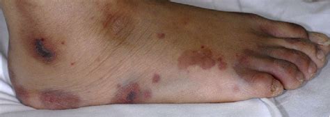 Purpuric Rash Over Upper And Lower Extremities Download Scientific Diagram