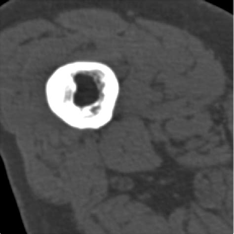 CT scan of distal femoral shaft shows thickened lateral femoral cortex ...