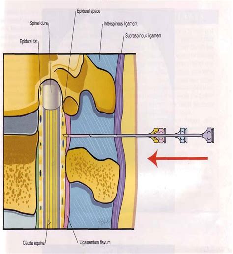Health From Trusted Sources Epidural Steroid Injections For Spinal Pain