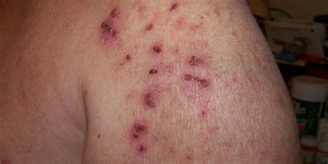 Morgellons Disease Causes, Signs and Symptoms