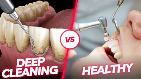 Deep Cleaning Vs Routine Cleaning Unveiling The Dental Cleaning