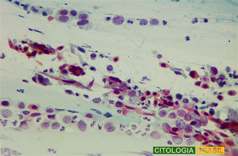 Carcinoma Escamoso Citologia Brasil