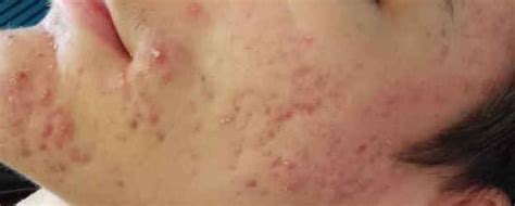 Akne Behandlung in Mainz - Hautarztpraxis Dr. Kirschner