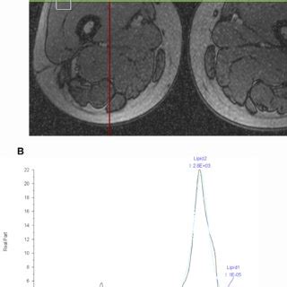 A 1 H MRS Voxel Placement From The Vastus Lateralis Muscle Of A