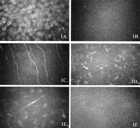 In Vivo Confocal Microscopy Of Patients With Corneal Recurrent Erosion