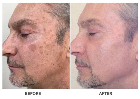 LASER SKIN RESURFACING | FOR YOUNGER, HEALTHIER SKIN