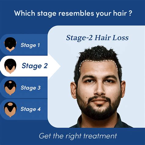 Buy Minoxidil 5 Topical Solution For Hair Loss And Regrowth Manmatters