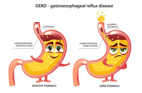 Estómago Sano Y Enfermedad De Reflujo Gastroesofágico Infográfico