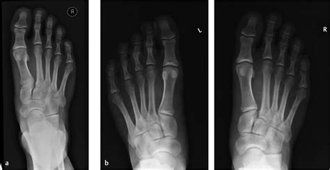 47 Midfoot Fractures And Dislocation Lisfrancs Injuries Musculoskeletal Key