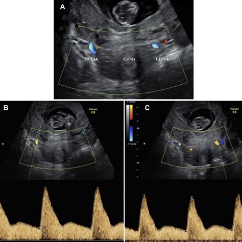 Uterine Artery Visualized By Color Doppler At The Level Of The Internal