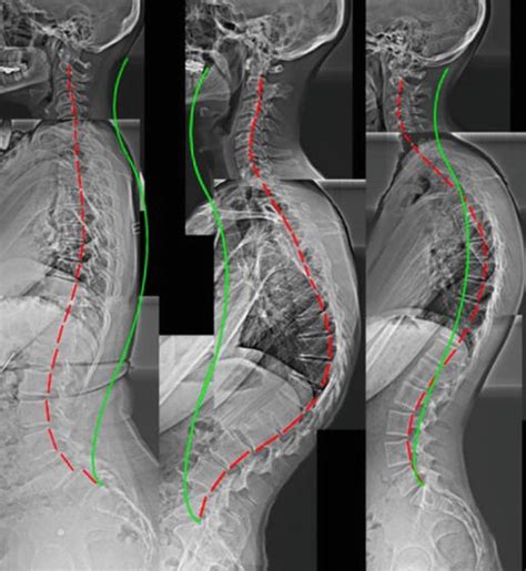 [34+] Cervical Lordosis Treatment At Home