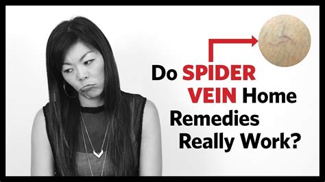 Spider Vein Home Treatment Before And After Results Youtube