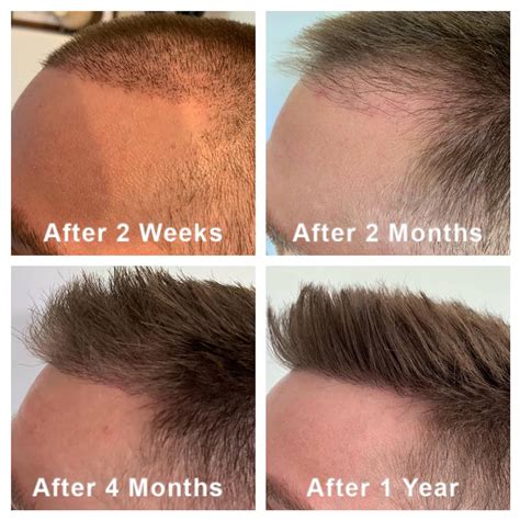 Top Months After Hair Transplant Polarrunningexpeditions