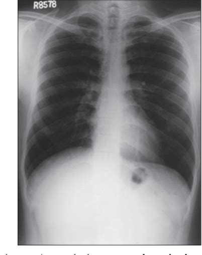 Figure 1 From Tubercular Osteomyelitis Of The Condyle And Ramus Of The Mandible A Case Report