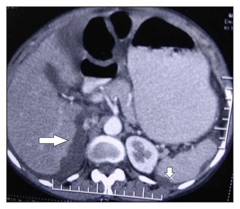 Pseudomyxoma Peritonei—an Unusual Cause Of Ascites A Case Report The Permanente Journal