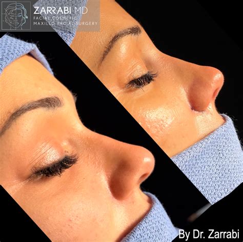 Closed Ultrasonic Piezo Rhinoplasty Dr Shahrouz Zarrabi Md