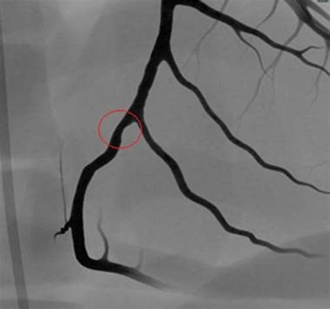 Angio Coronary Bifurcations Simbionix