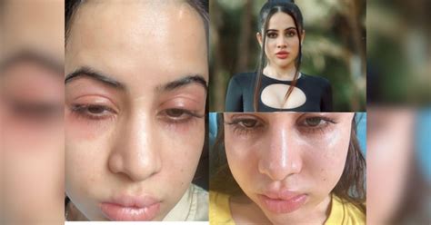 Uorfi Face Deteriorates Urfi Javed Swollen Face Allergies Latest Photos
