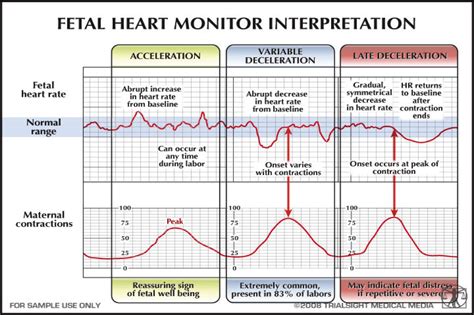 Early Variable Late Decels Early Reassuring Variable Cord