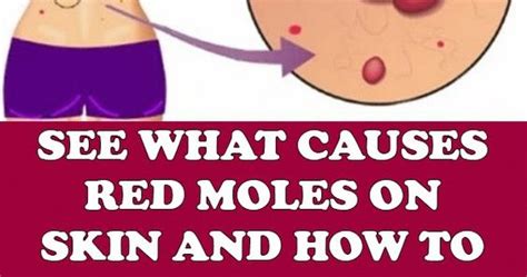 What Causes Red Moles On Skin And How To Get Rid Of Them HEALTHIER PRESS