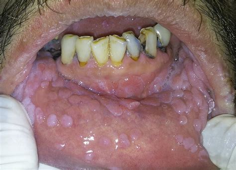 SciELO Brasil Unusual Presentation Of A Disseminated Oral HPV