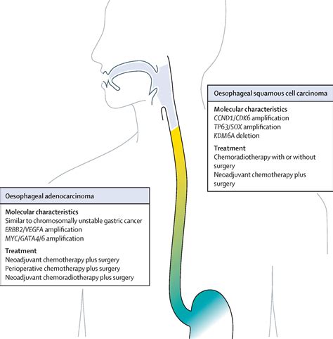 Oesophageal Cancer The Lancet