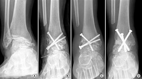 A Preoperative Standing Radiograph Shows Medial Compartment Ankle