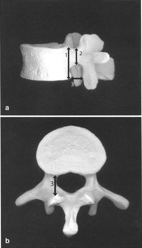 Fig La B Lateral And Caudal View Of A Vertebra With Definition Of