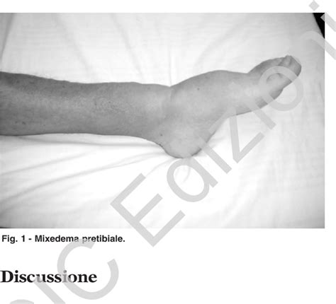 Figure 1 from Mixedema pretibiale: case report | Semantic Scholar