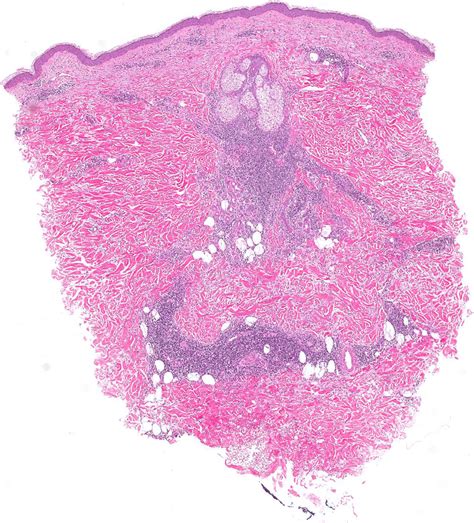 Histopathologic Findings From Lesional Specimens Hematoxylin And