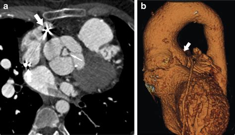 Aortic Regurgitation And Dilation Post Tetralogy Of Fallot Repair And Download Scientific