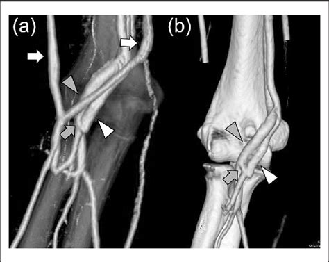 Iatrogenic Arteriovenous Fistula In The Brachial Artery After