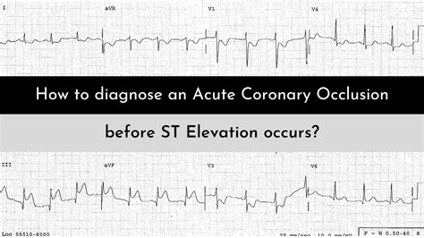 STEMI NSTEMI Vs OMI NOMI A Paradigm Shift In ECG Interpretation Of MI