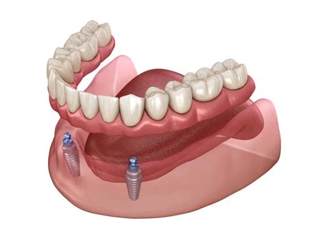 How Dental Implants Secure Your Dentures