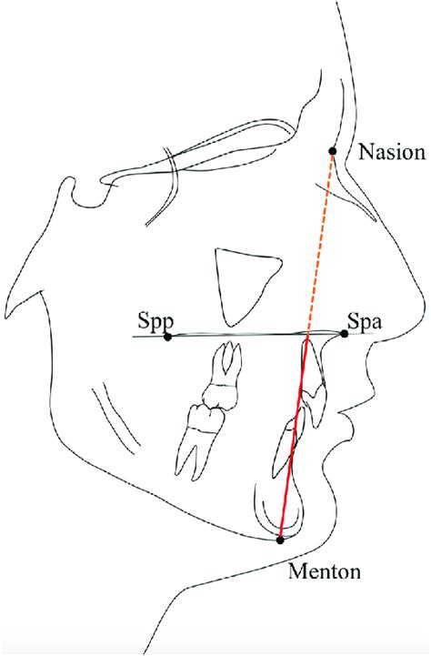 Lateral Cephalometric Tracing Showing The Measurement Of The Lower