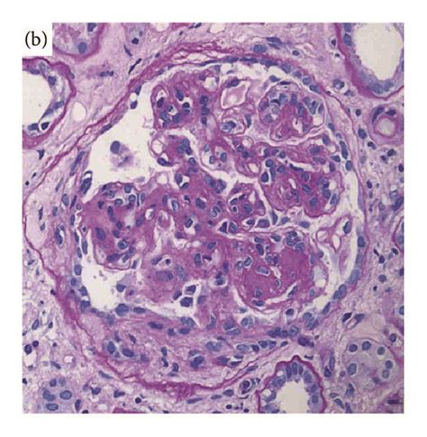 Light Microscopy Findings In The Renal Biopsy Specimen Glomeruli