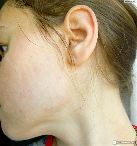 Крем НПО Петровакс Фарм Имофераза - «Помогает, но медленно...» | отзывы