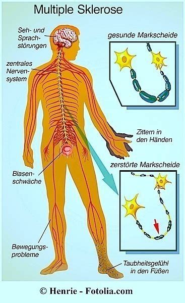 Multiple Sklerose Symptome Ursachen Und Verlauf