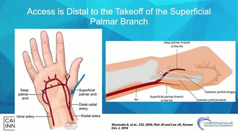 Distal Radial State Of The Art Ethan Korngold Md Youtube